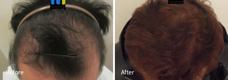 /filedata/md_board/20260102171507_XOhFPioj_afterEBAAA8EBB09CEC9DB4EC8B9D_14.jpg 전후사진