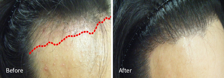 /filedata/md_board/20260102171617_mVckT5Az_afterEBAAA8EBB09CEC9DB4EC8B9D_16.jpg 전후사진