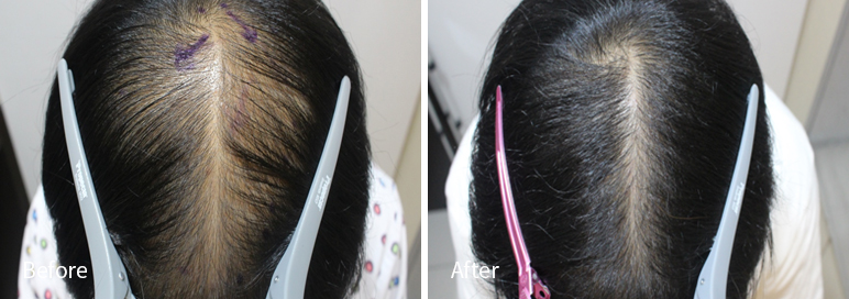 /filedata/md_board/20260102171755_pEbheoVg_afterEBAAA8EBB09CEC9DB4EC8B9D_21.jpg 전후사진