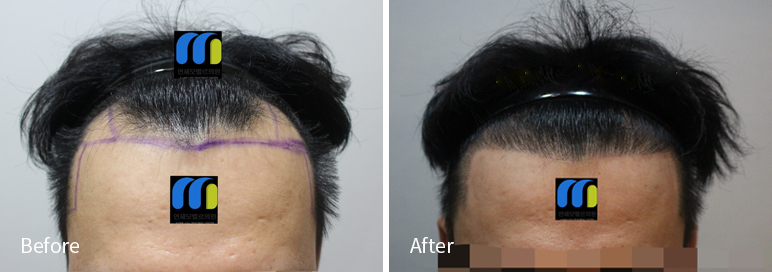 /filedata/md_board/20260102171826_53IaBC1s_afterEBAAA8EBB09CEC9DB4EC8B9D_23.jpg 전후사진