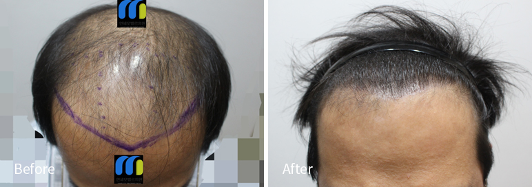 /filedata/md_board/20260102171856_eRI9V1kD_afterEBAAA8EBB09CEC9DB4EC8B9D_25.jpg 전후사진