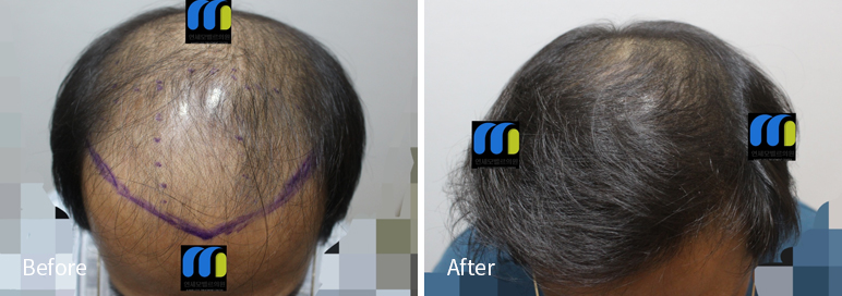 /filedata/md_board/20260102171910_KIXO8z3t_afterEBAAA8EBB09CEC9DB4EC8B9D_26.jpg 전후사진