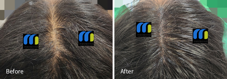 /filedata/md_board/20260102182208_lEux9WK2_afterEB9190ED94BCEBACB8EC8BA0_12.jpg 전후사진