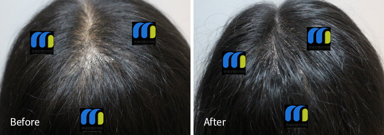 /filedata/md_board/20260102182241_T675mowM_afterEB9190ED94BCEBACB8EC8BA0_14.jpg 전후사진