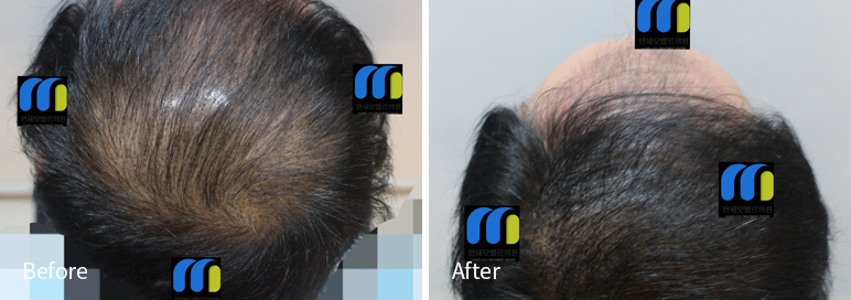 /filedata/md_board/20260102182256_iXcnqsgB_afterEB9190ED94BCEBACB8EC8BA0_15.jpg 전후사진