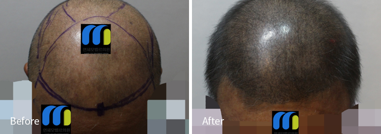 /filedata/md_board/20260102182315_fXjoxuPv_afterEB9190ED94BCEBACB8EC8BA0_16.jpg 전후사진