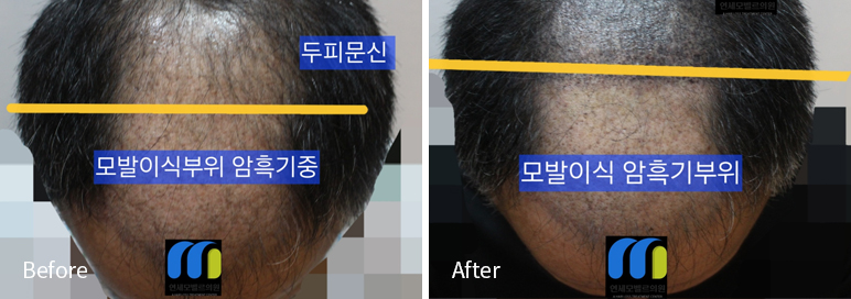 /filedata/md_board/20260102182329_3sUPuQR7_afterEB9190ED94BCEBACB8EC8BA0_17.jpg 전후사진