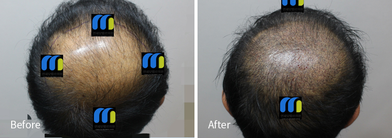 /filedata/md_board/20260102182345_cgye2Fs9_afterEB9190ED94BCEBACB8EC8BA0_18.jpg 전후사진