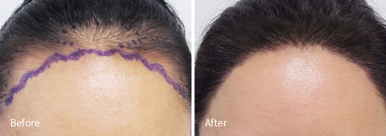 /filedata/md_board/20260102182847_Xr6lOnGR_afterED97A4EC96B4EB9DBCEC9DB8_2.jpg 전후사진