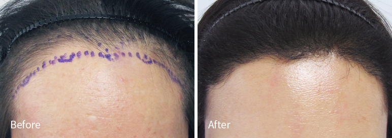 /filedata/md_board/20260102182930_bLnszJYZ_afterED97A4EC96B4EB9DBCEC9DB8_4.jpg 전후사진