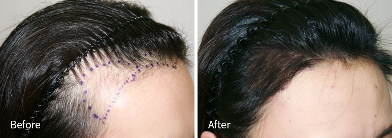 /filedata/md_board/20260102183011_9Yha1prK_afterED97A4EC96B4EB9DBCEC9DB8_7.jpg 전후사진