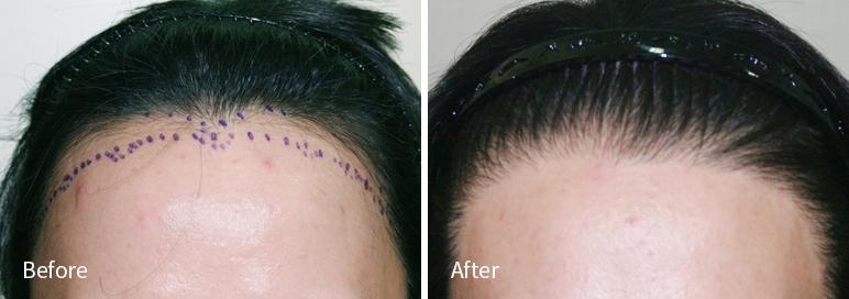 /filedata/md_board/20260102183032_fgKkzFUh_afterED97A4EC96B4EB9DBCEC9DB8_8.jpg 전후사진