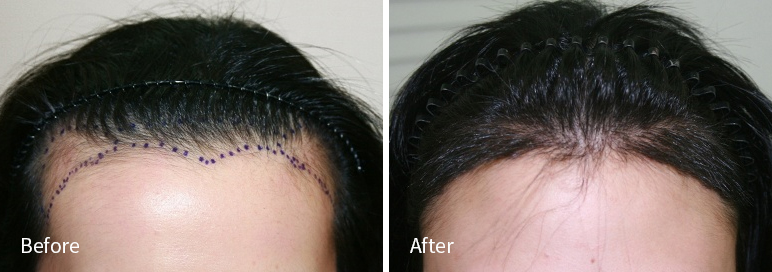 /filedata/md_board/20260102183143_jevtYJUp_afterED97A4EC96B4EB9DBCEC9DB8_13.jpg 전후사진