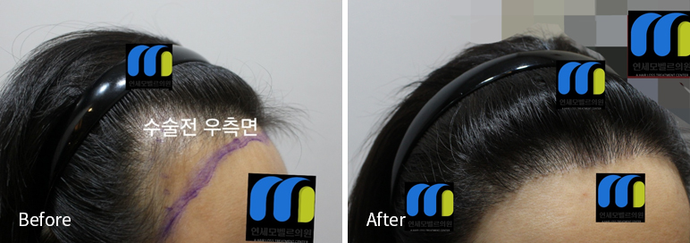 /filedata/md_board/20260102183156_TnDrsQYd_afterED97A4EC96B4EB9DBCEC9DB8_14.jpg 전후사진