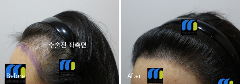 /filedata/md_board/20260102183211_wiKh70aC_afterED97A4EC96B4EB9DBCEC9DB8_15.jpg 전후사진